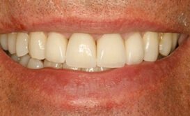 dental crowns and bridges koramangala