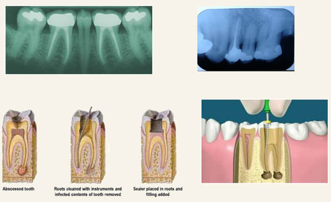 endodontist in koramangala